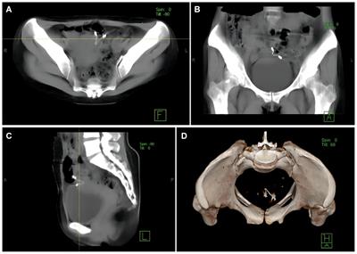 Case report: Uterine perforation caused by migration of intrauterine devices